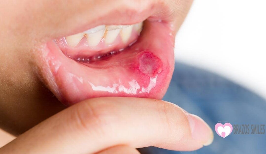 Bump and  Sores in The Roof of The Mouth